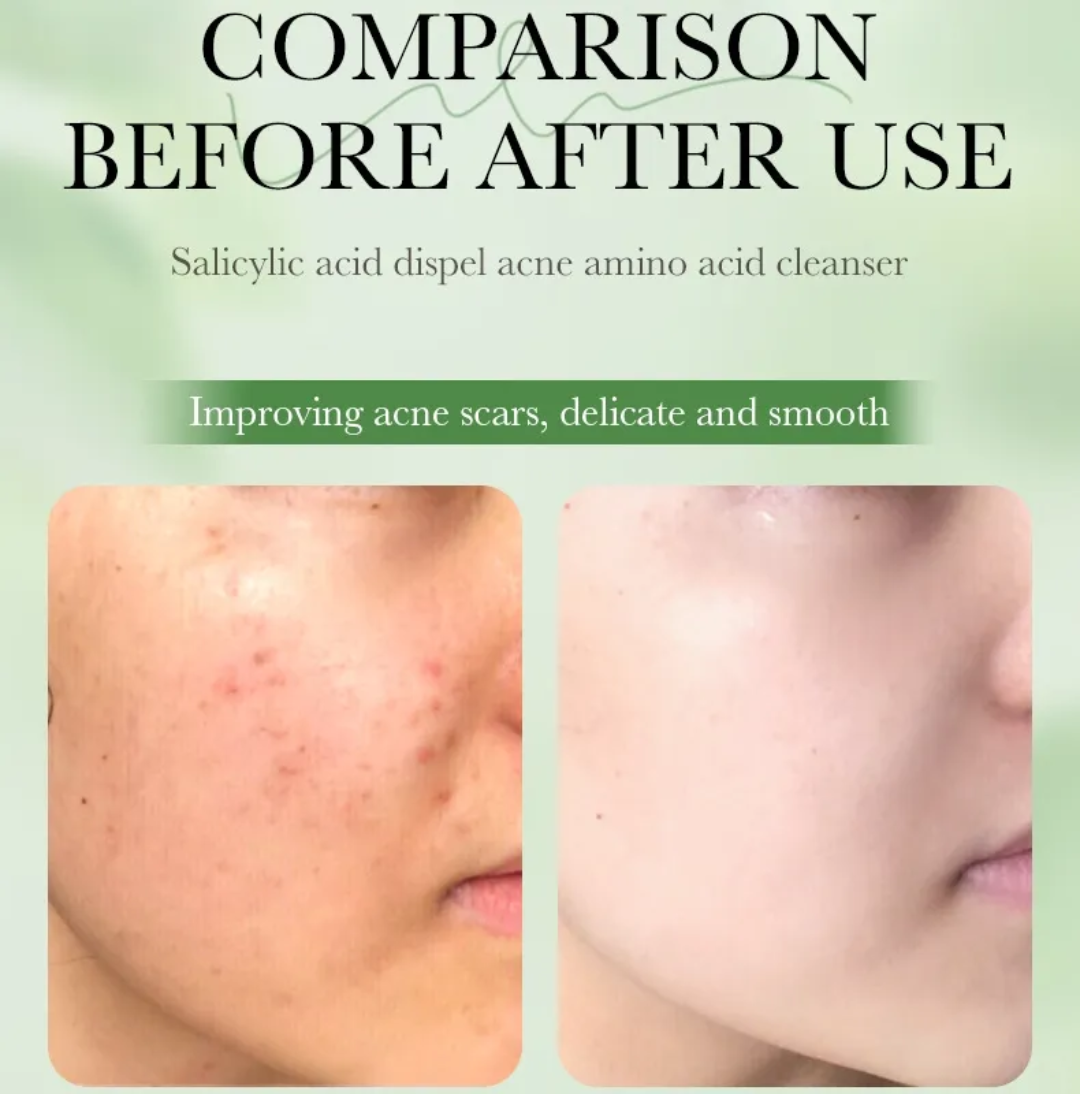Sadoer Salicylc Acid 3%Amino Acid Gentle Face Cleanser 100g